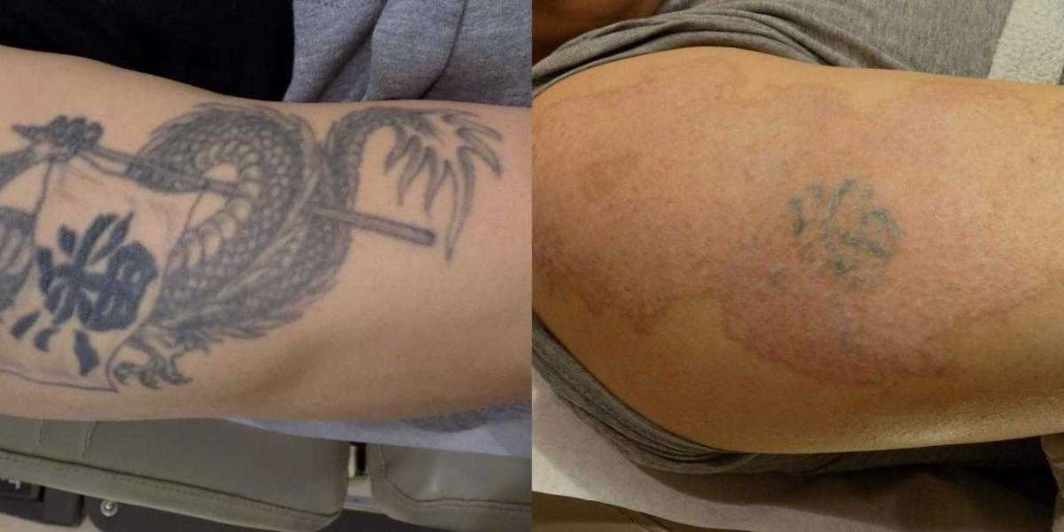 Tattoo Removal in Brentwood: Before & After Expectations