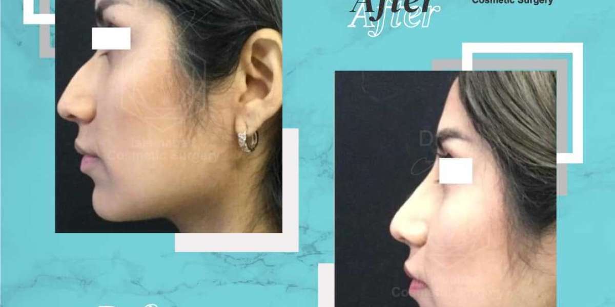 Where to Find Trusted Rhinoplasty in Islamabad for Safe Results