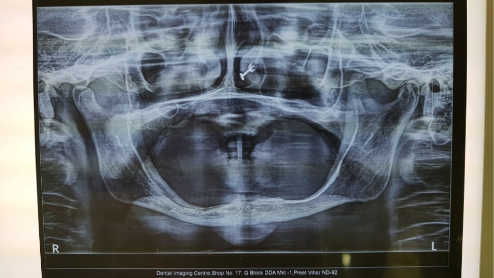 Permanent Dental Implants Treatment in Delhi-NCR