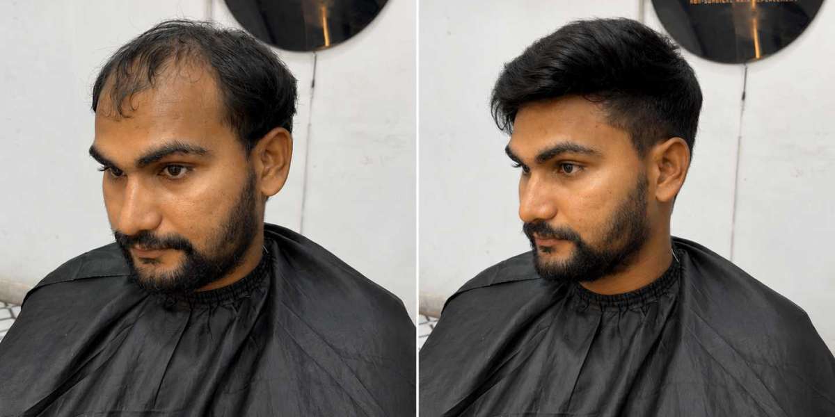 Best Hair Patch in Dwarka: Restore Your Hair Naturally with Expert Care