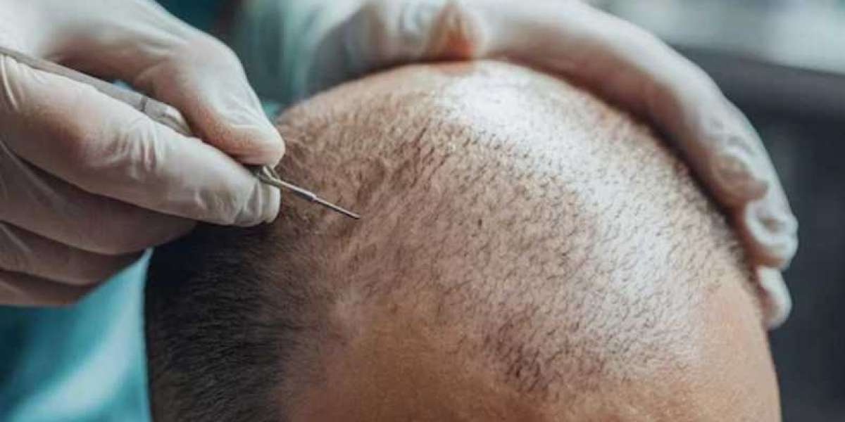 Why Hair Transplant Costs Can Vary More Than You Think?