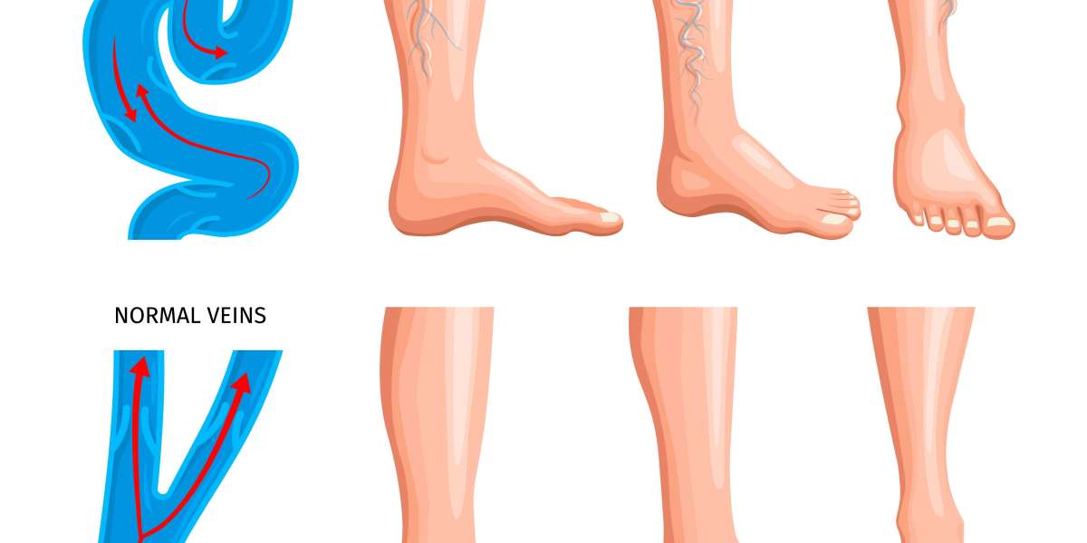 What Causes Varicose Veins? Risk Factors, Symptoms & Treatment