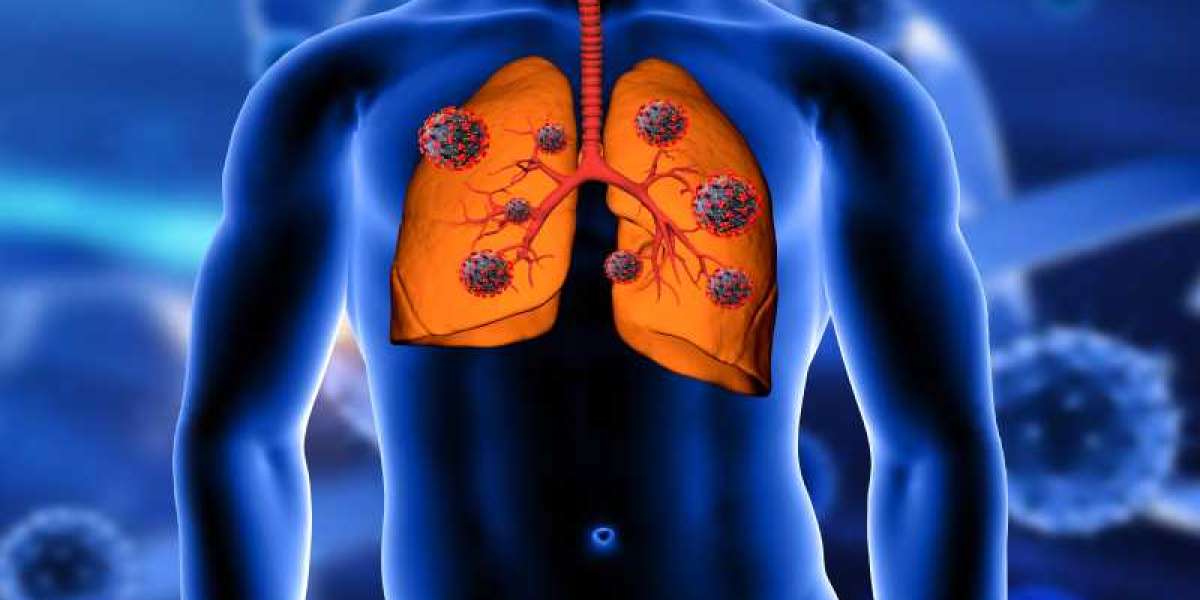 Lung Cancer Symptoms: Early Signs, Risk Factors, Diagnosis and Treatment Cost