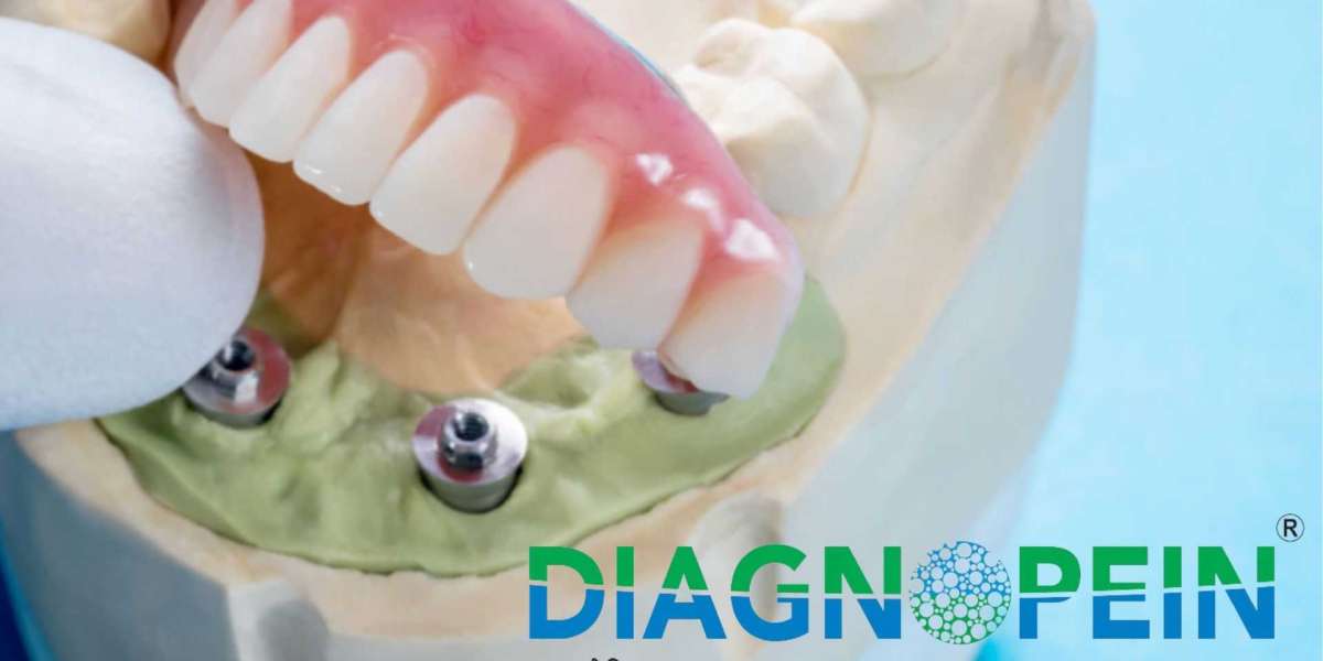 Dental Implant Cost in Mumbai – Your Complete Dental Guide
