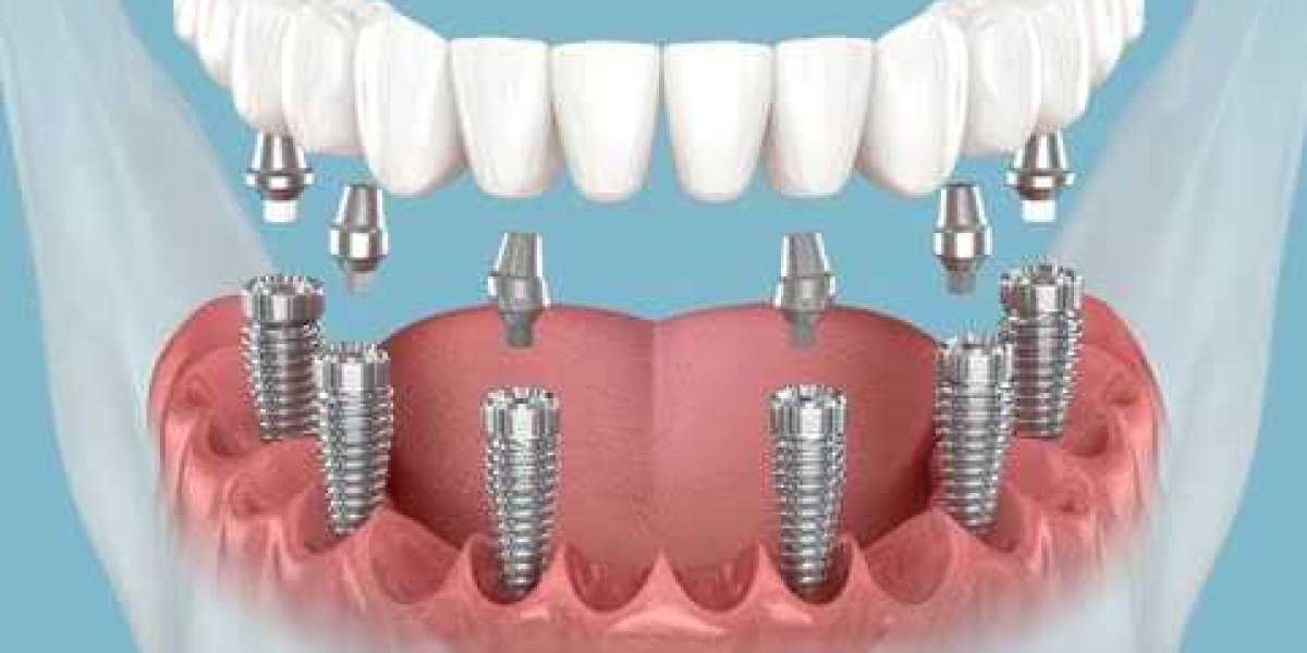 Dental Implant Cost in Mumbai – Single & Multiple Implants